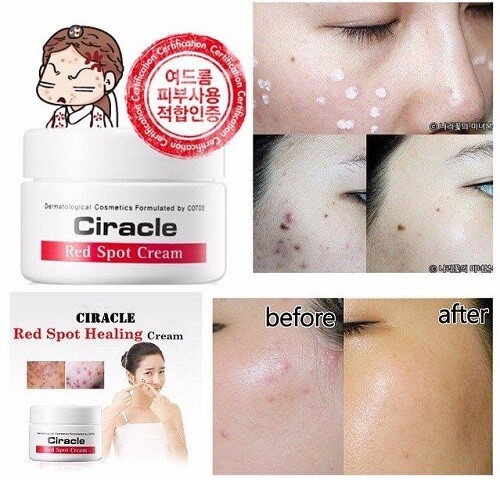     Anti Acne Red Spot Cream Ciracle (,  2)